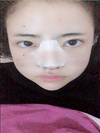 我的隆鼻整形恢復果圖  塌鼻子逆襲記