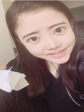 我的隆鼻整形恢復果圖  塌鼻子逆襲記