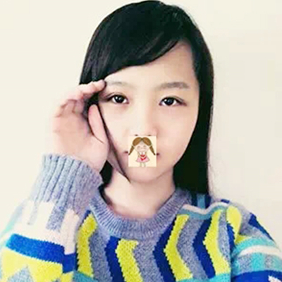 德陽金榮盧元剛埋線雙眼皮案例