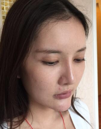 這是我做埋埋蛋白線.提升前拍的照片,看得出來面部肌膚走向下垂,皮膚松弛了