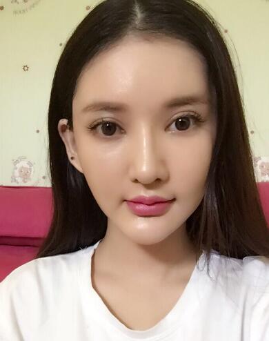 面部面b提升恢復(fù)日記和恢復(fù)圖片,一周左右恢復(fù)自然