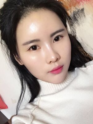 自體脂肪填充全臉經(jīng)歷，臉型超**的