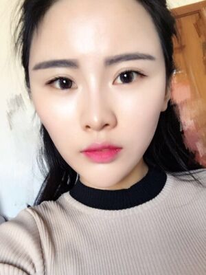 自體脂肪填充全臉經(jīng)歷，臉型超**的
