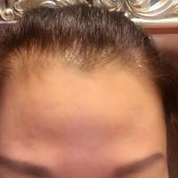 去抬頭紋很好的方法是注射注射瘦臉，恢復過程圖分享