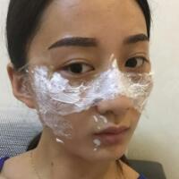 有誰(shuí)做過激光祛雀斑？個(gè)人激光祛雀斑后恢復(fù)日記分享