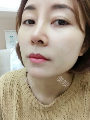 成都隆鼻整形整真實(shí)恢復(fù)圖片，終于有了韓式小翹鼻