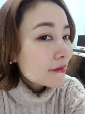 成都隆鼻整形整真實(shí)恢復(fù)圖片，終于有了韓式小翹鼻