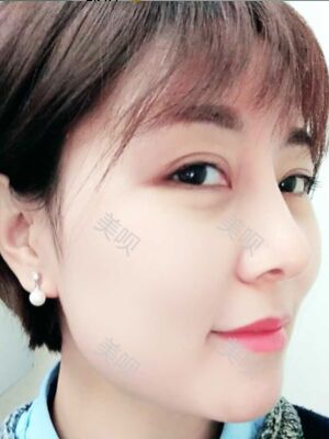 成都隆鼻整形整真實(shí)恢復(fù)圖片，終于有了韓式小翹鼻