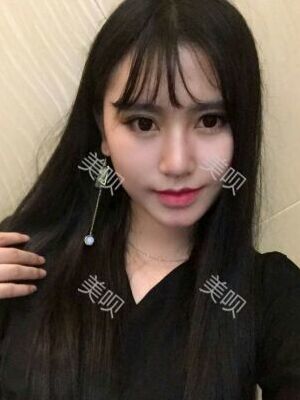 線D隆鼻恢復(fù)過程圖片，真實案例照片