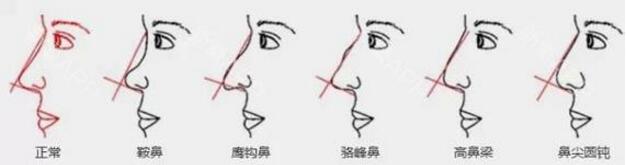 鼻型介紹，上海藝星整形美容醫(yī)院整形價格表大曝光