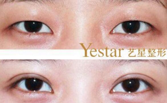 割雙眼皮整形圖片，上海藝星整形美容醫(yī)院整形價格表大曝光