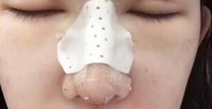 隆鼻失敗修復后恢復圖分享,鼻子修復價格9800元