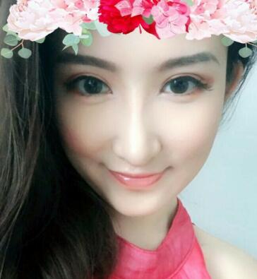 隆鼻失敗修復后恢復圖分享,鼻子修復價格9800元