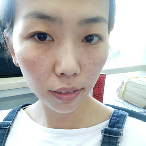 激光祛曬斑真實案例分享，并附上前后對比圖片