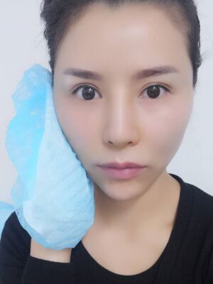 臉部埋埋蛋白線.提升果圖，真實經(jīng)歷分享