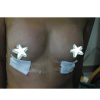 自體脂肪移植隆胸果圖分享，吸脂隆胸價(jià)格18800元