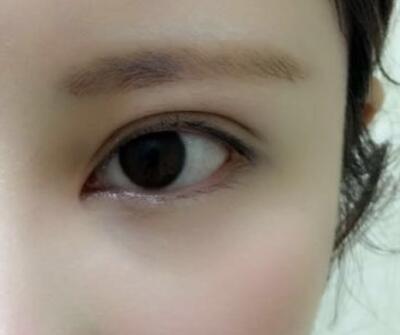 開內(nèi)眼角割雙眼皮恢復(fù)全過(guò)程和圖片分享,雙眼皮多項(xiàng)整形整形