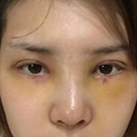 做了割雙眼皮和開內(nèi)眼角雙眼皮多項整形整形手術(shù)，恢復(fù)圖片日志分享