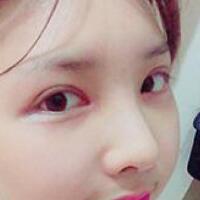 做了割雙眼皮和開內(nèi)眼角雙眼皮多項整形整形手術(shù)，恢復(fù)圖片日志分享