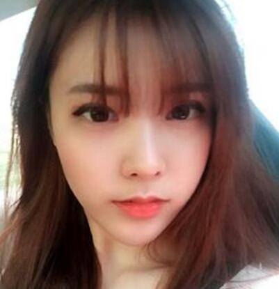 做了割雙眼皮和開(kāi)內(nèi)眼角雙眼皮多項(xiàng)整形整形手術(shù),恢復(fù)圖片日志分享