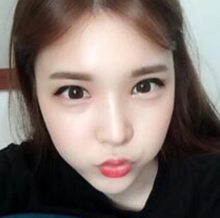 做了割雙眼皮和開(kāi)內(nèi)眼角雙眼皮多項(xiàng)整形整形手術(shù),恢復(fù)圖片日志分享