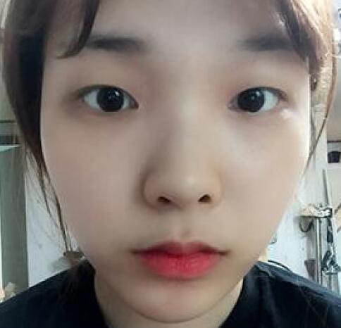 做了割雙眼皮和開(kāi)內(nèi)眼角雙眼皮多項(xiàng)整形整形手術(shù),恢復(fù)圖片日志分享