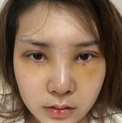 做了割雙眼皮和開(kāi)內(nèi)眼角雙眼皮多項(xiàng)整形整形手術(shù),恢復(fù)圖片日志分享
