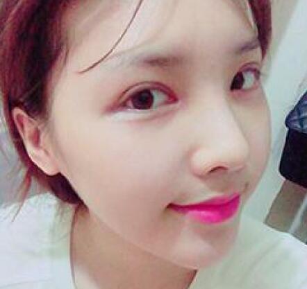 做了割雙眼皮和開(kāi)內(nèi)眼角雙眼皮多項(xiàng)整形整形手術(shù),恢復(fù)圖片日志分享