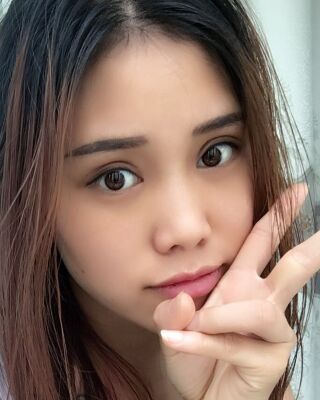 雙眼皮失敗修復(fù)果圖，福州愛(ài)美爾王召克做的