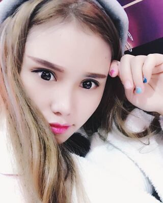 雙眼皮失敗修復(fù)果圖，福州愛(ài)美爾王召克做的