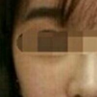 在濟(jì)南吉芙醫(yī)院做的玻尿酸填充淚溝，填充淚溝圖片分享