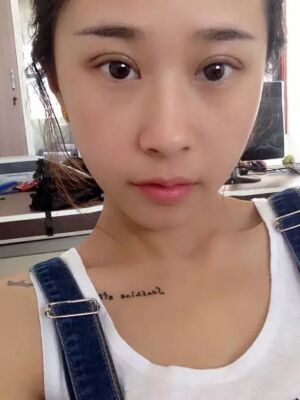 福州美貝爾切開(kāi)雙眼皮成功案例前后對(duì)比圖