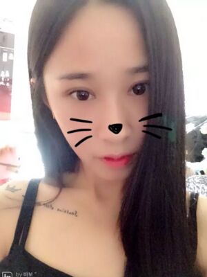 福州美貝爾切開(kāi)雙眼皮成功案例前后對(duì)比圖