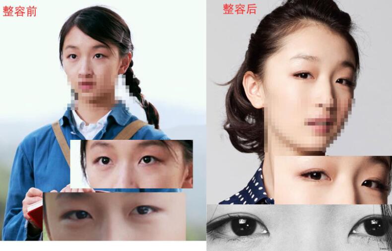 周冬雨割單眼皮前后對比圖，單眼皮割雙眼皮價格和果圖