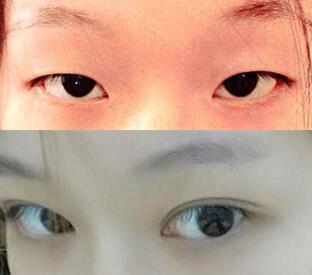 單眼皮割雙眼皮價格和果圖