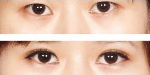 單眼皮割雙眼皮價格和果圖