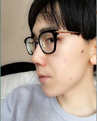 男生隆鼻整形案例分享，福州美貝爾張潮做的