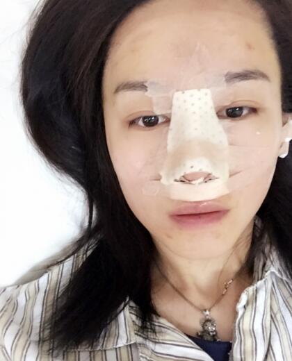 哈爾濱假體隆鼻價(jià)格8900元，隆鼻真實(shí)案例分享