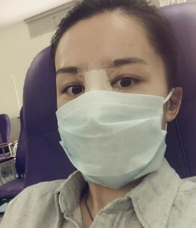 哈爾濱假體隆鼻價(jià)格8900元，隆鼻真實(shí)案例分享