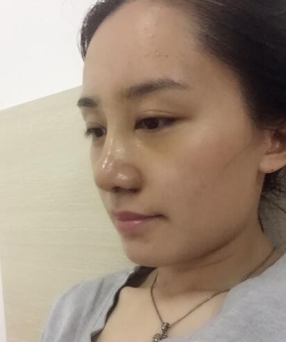 哈爾濱假體隆鼻價(jià)格8900元，隆鼻真實(shí)案例分享