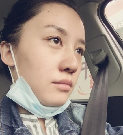 哈爾濱假體隆鼻價(jià)格8900元，隆鼻真實(shí)案例分享