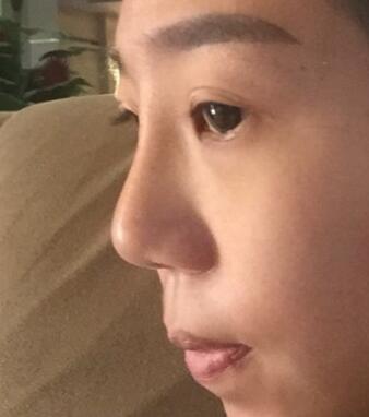 假體隆鼻術(shù)后注意事項(xiàng)和恢復(fù)過(guò)程圖分享