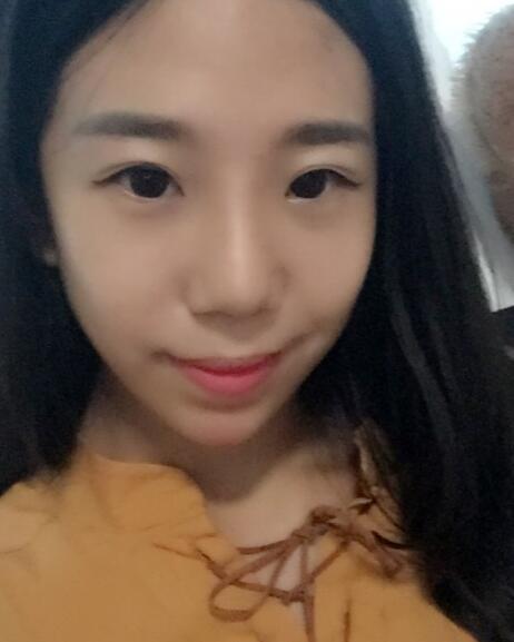 假體隆鼻術(shù)后注意事項(xiàng)和恢復(fù)過(guò)程圖分享