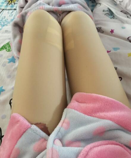 吸脂塑身醫(yī)院推薦歐蘭仁美醫(yī)院,吸脂瘦腿恢復(fù)圖分享