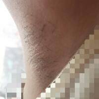 激光脫毛的價(jià)格380元，圖片分享