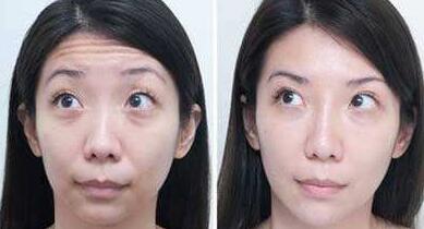 抬頭紋手術(shù)多少錢？去抬頭紋前后對比圖