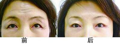 抬頭紋手術(shù)多少錢？去抬頭紋前后對比圖