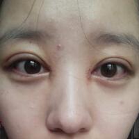 見(jiàn)證全切雙眼皮使單眼皮變雙眼皮的奇跡~恢復(fù)過(guò)程圖分享