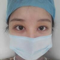 見(jiàn)證全切雙眼皮使單眼皮變雙眼皮的奇跡~恢復(fù)過(guò)程圖分享