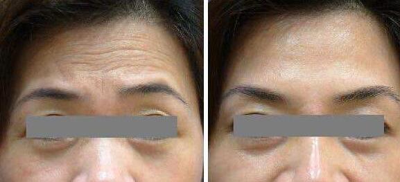 去抬頭紋前后對比圖，去抬頭紋手術多少錢？